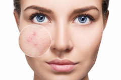Young woman with acne skin in zoom circle.